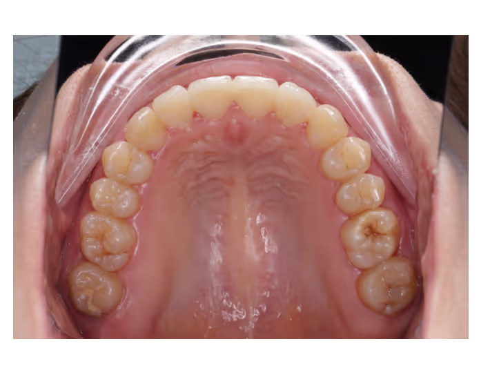 Après : Traitement Invisalign réalisé au cabinet White & Care