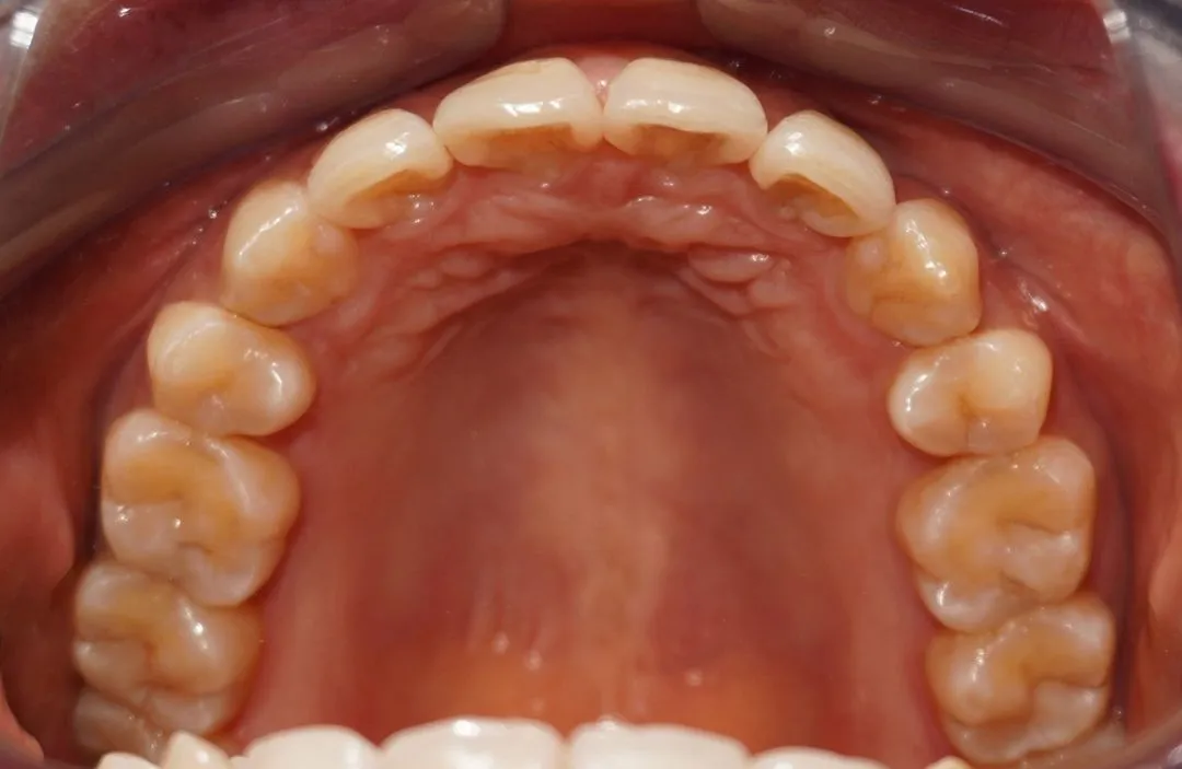 Après : Traitement Invisalign réalisé au cabinet White & Care