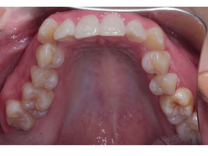 Avant : Traitement Invisalign réalisé au cabinet White & Care