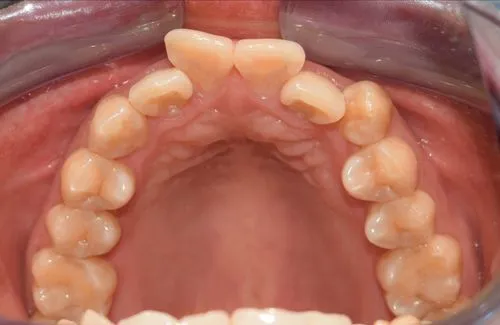 Avant : Traitement Invisalign réalisé au cabinet White & Care