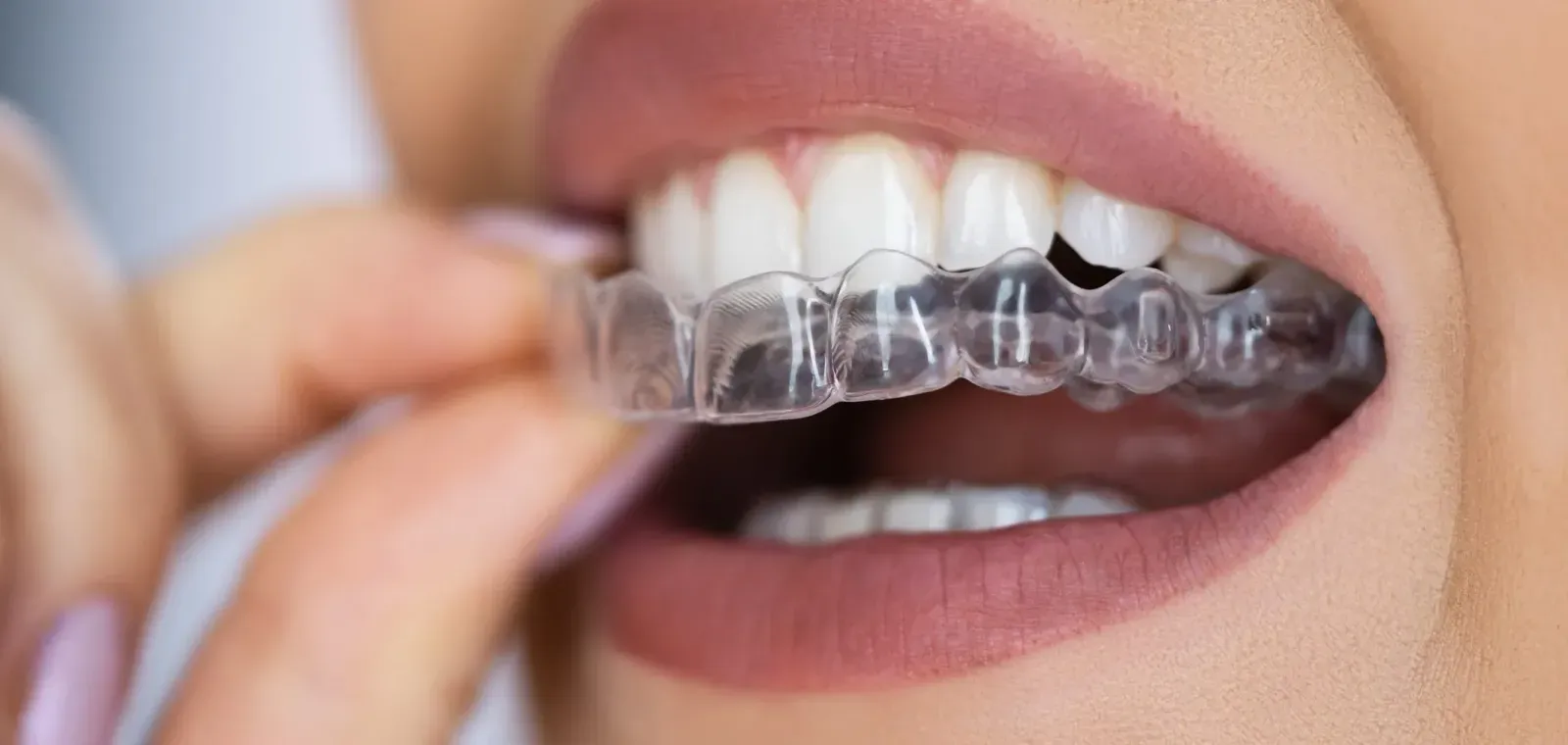 Gouttières Invisalign au cabinet White & Care à Anderlecht